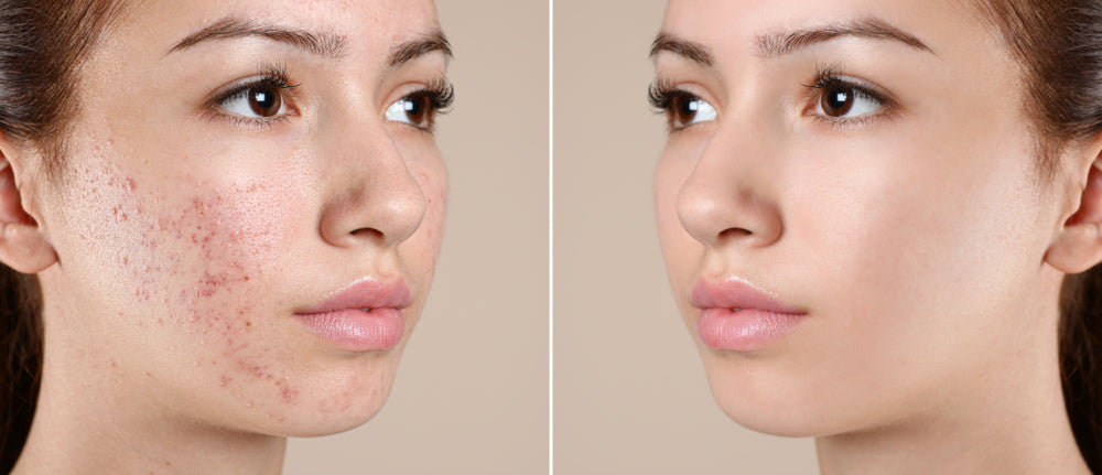 Facial Treatment Methods for Various Skin Issues